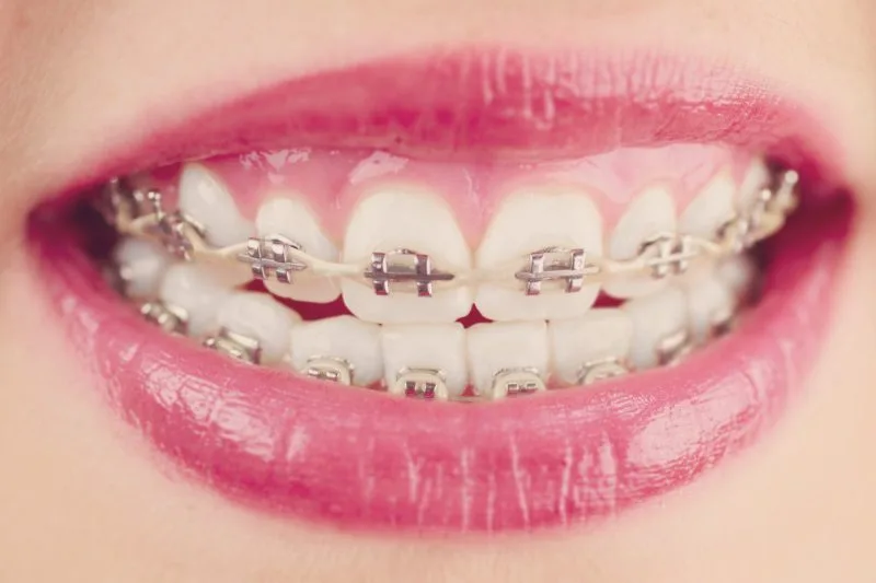 Are Power Chains The Last Step In Braces?