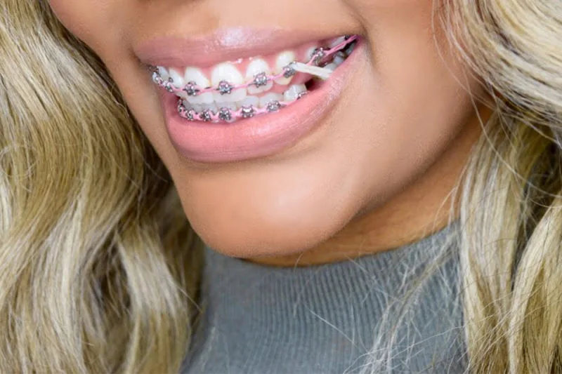 Are Power Chains The Last Step In Braces? Power Chains Simply Explained 3 Are Power Chains The Last Step In Braces- Different Types Of Powerchains
