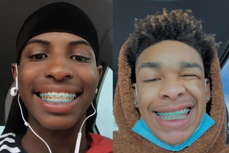 Best Braces Colors For Guys Best Braces Colors For Dark Skin Teal