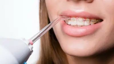 Best Water Flosser For Braces