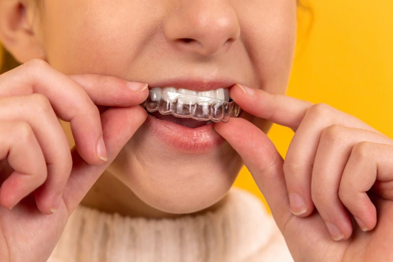Can You Get Discounts On Braces & Invisalign Deals For Black Friday? 2 Black Friday Braces Invisalign Deals - Invisalign Black Friday offers