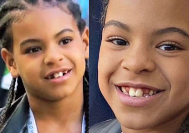 Check Out Blue Ivy Carter's Braces! Beyoncé & Jay-Z's Daughter 4 Blue Ivy Carter Braces - Before Braces