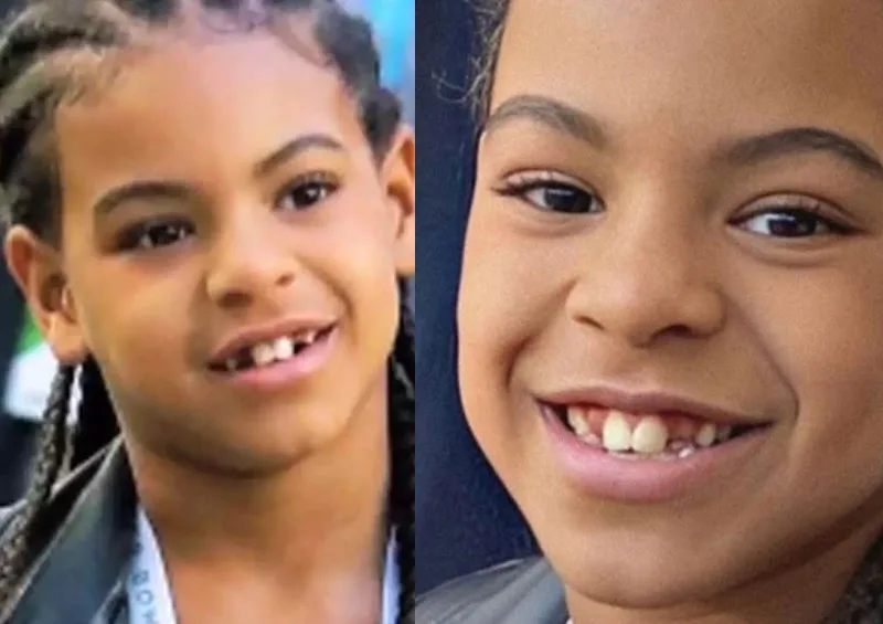 Check Out Blue Ivy Carter's Braces! Beyoncé & Jay-Z's Daughter 4 Blue Ivy Carter Braces - Before Braces
