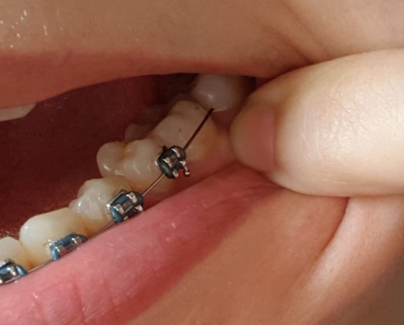 Braces Broken Brackets - Bracket Slipped off of the back tooth