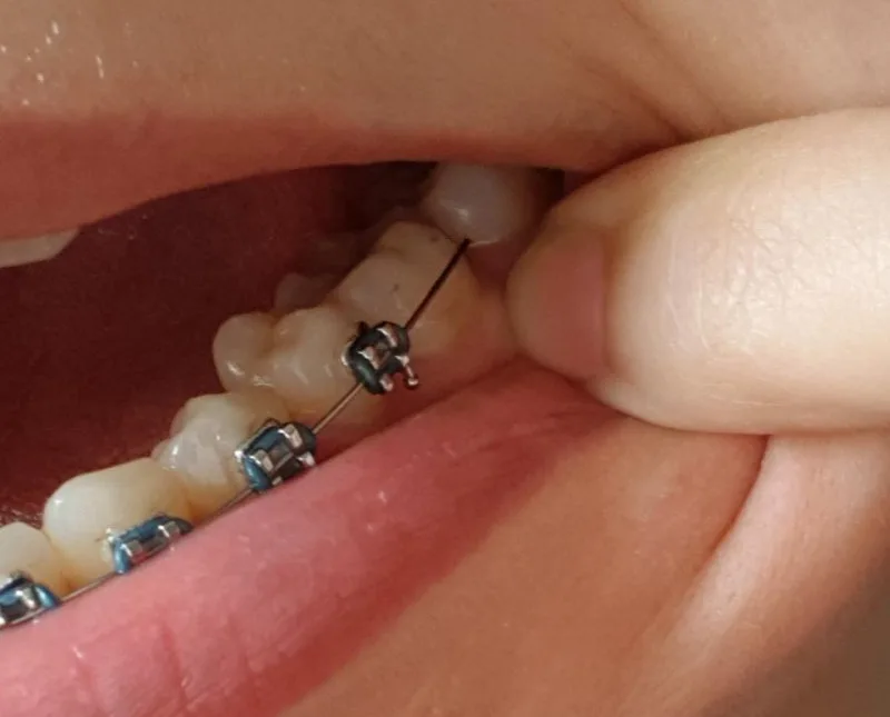 Broken Bracket On Braces? The 3 Things You NEED To Do 3 Braces Broken Brackets - Bracket Slipped off of the back tooth