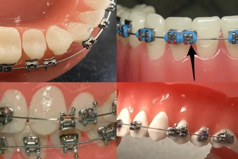 Broken Bracket On Braces? The 3 Things You NEED To Do 2 Braces Broken Brackets - Loose Bracket - What To Do If Your Break A Bracket