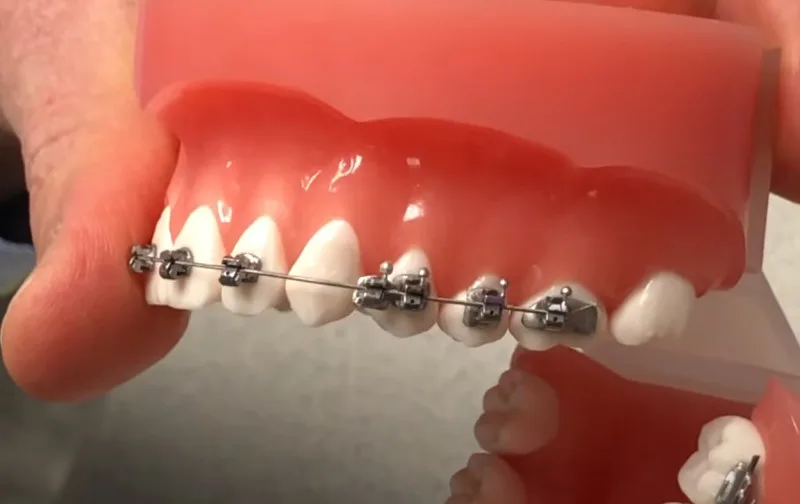 Broken Bracket On Braces? The 3 Things You NEED To Do 4 Braces Broken Brackets - What to do if bracket breaks