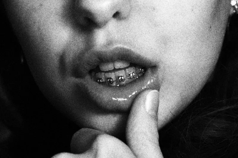 Can You Eat Braces Wax? What You Need To Know If You've Just Swallowed Some! 2 https://bracesjourney.com/can-you-eat-braces-wax/