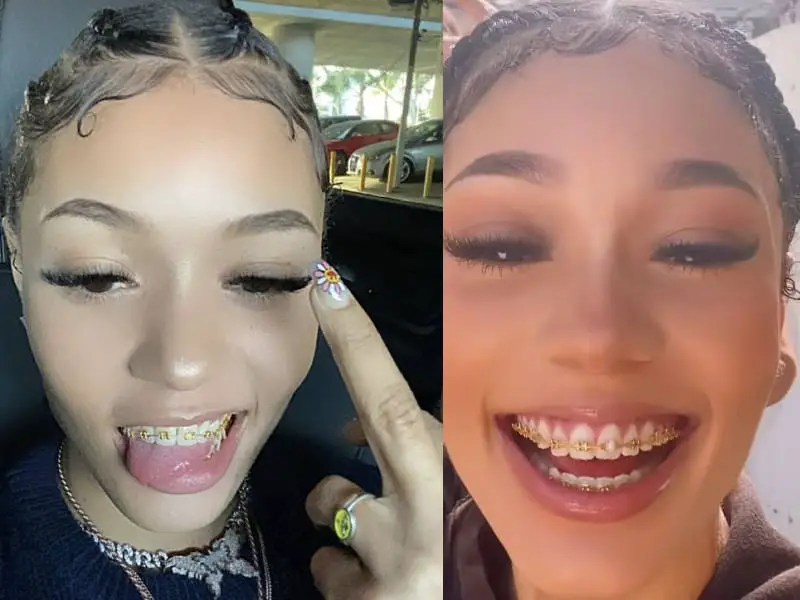 Coi Leray Gets Her Braces Off! Were Coi Leray's Gold Braces Real? 4 Coi Leray With Braces - Gold Braces