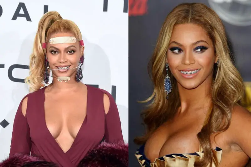 Did Beyonce Have Braces? - The Truth + Proof! 3 Did Beyonce Have Braces - Beyonce With Braces FAKE
