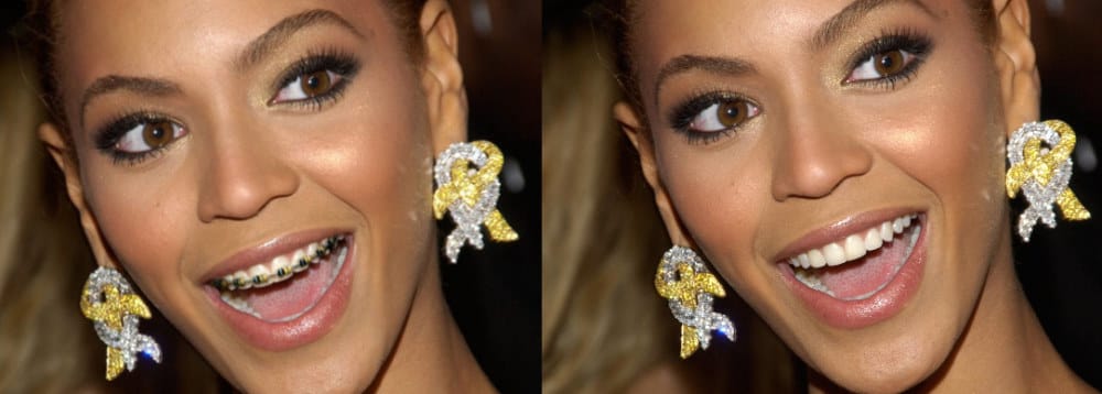 Did Beyonce Have Braces? - The Truth + Proof! 2 Did Beyonce Have Braces - Original