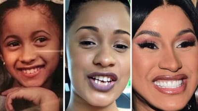 Did Cardi B Get Braces Invisalign Veneers
