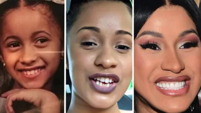 Did Cardi B Get Braces Invisalign Veneers