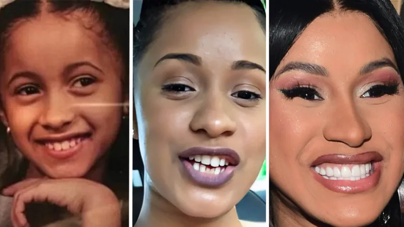 Did Cardi B Get Braces Invisalign Veneers