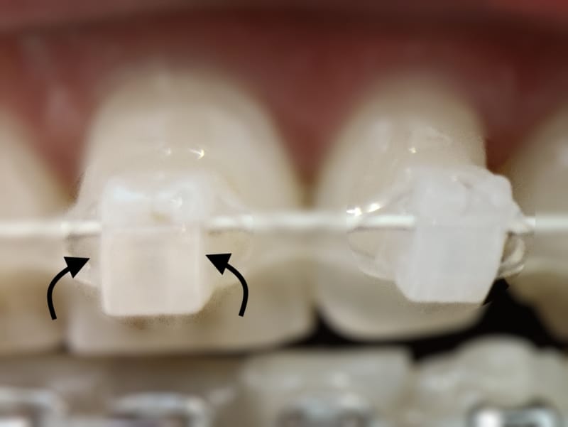 Do Clear Braces Turn Yellow? Real Results + Quick Fixes For Ceramic Braces Stains 3 Do Clear Braces Turn Yellow Food Stuck Inside Bracket