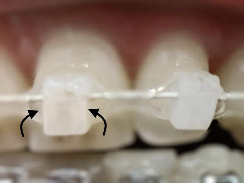 Do Clear Braces Turn Yellow? Real Results + Quick Fixes For Ceramic Braces Stains 3 Do Clear Braces Turn Yellow Food Stuck Inside Bracket