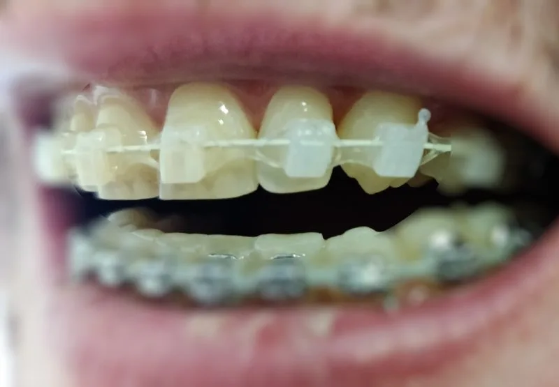 Do Clear Braces Turn Yellow? Real Results + Quick Fixes For Ceramic Braces Stains 2 Do Clear Bracs Turn Yellow Ceramic Braces Stain