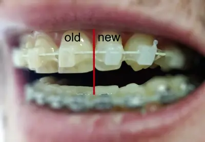 Do Clear Bracs Turn Yellow - Ceramic Braces Stain - Old and New Compared