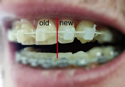 Do Clear Bracs Turn Yellow - Ceramic Braces Stain - Old and New Compared