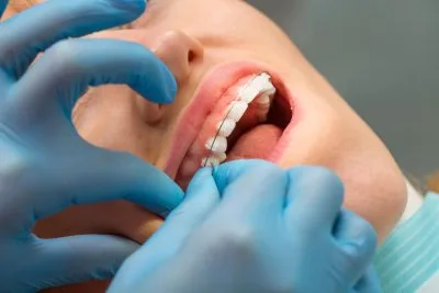 Do You Get Top And Bottom Braces On The Same Day?