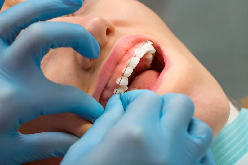 Do You Get Top And Bottom Braces On The Same Day?