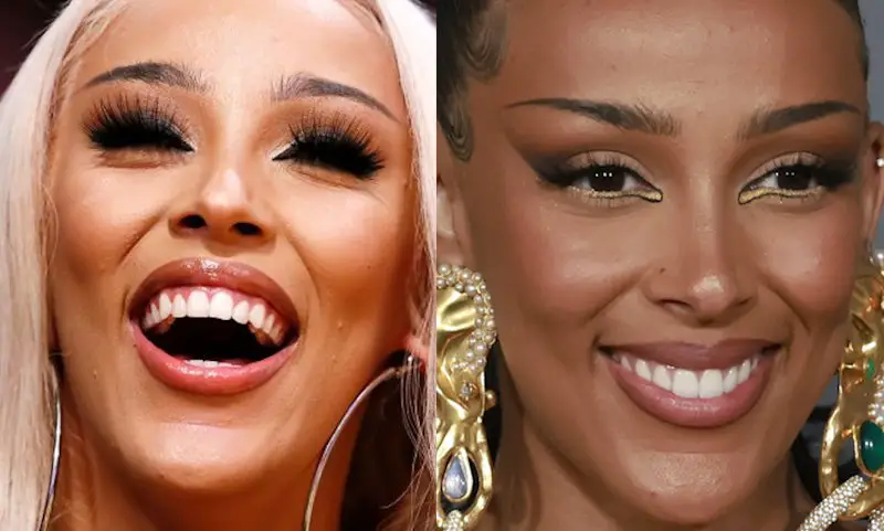 Doja Cat's Teeth Before and After Veneers + SERIOUSLY Bad Dental Hygiene 4 Doja Cat Teeth After Veneers