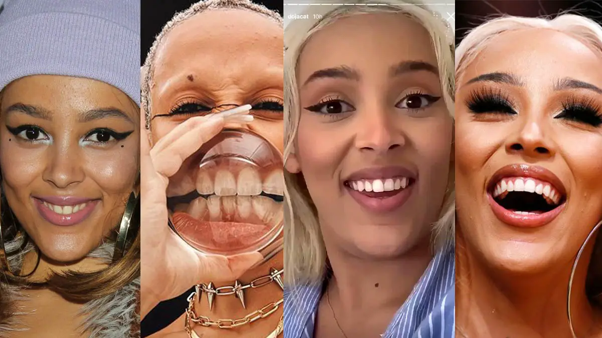 Doja Cat S Teeth Before And After Veneers Seriously Bad Dental