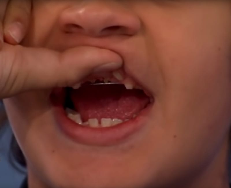 Gaten Matarazzo Braces Dustin From Stranger Things Teeth