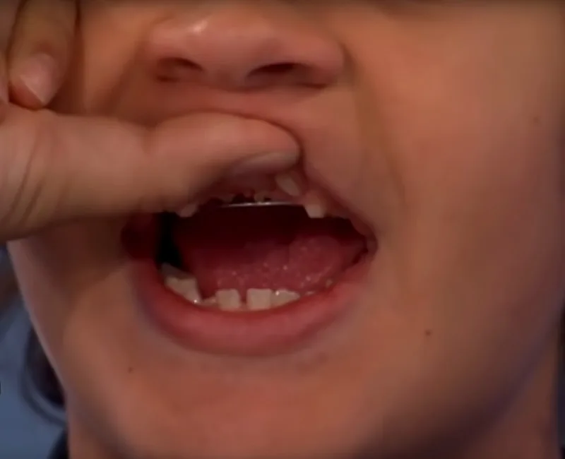 Gaten Matarazzo's Braces - Check Out Dustin From Stranger Things New Braces In Season 4! 6 Gaten Matarazzo Braces Dustin From Stranger Things Teeth