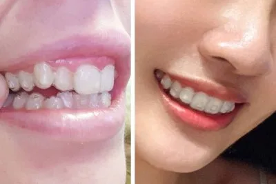 Invisalign Attachments Fell Off