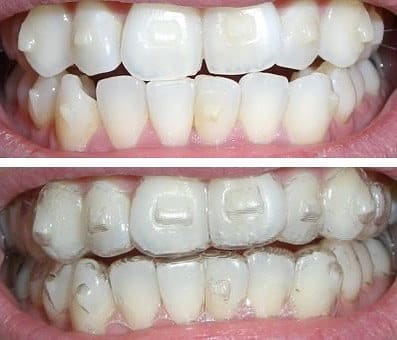 Help! My Invisalign Attachments Fell Off! What You Need To Do 2 Invisalign Attachments Fell Off - Invisalign Attchment Placement
