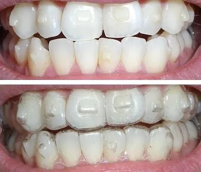 Invisalign Attachments Fell Off - Invisalign Attchment Placement