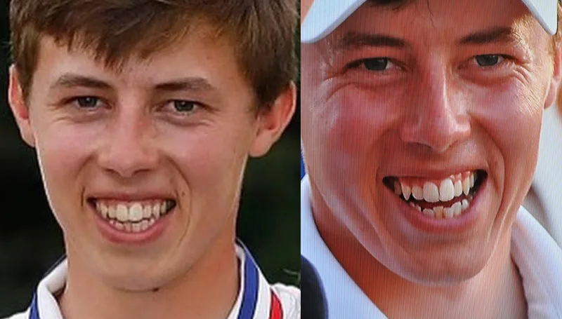 Does Matt Fitzpatrick Have Braces? See The US Open Winner's Adult Braces! 3 Matt Fitzpatrick Braces - Matt Fitzgerald Teeth Before Braces