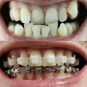 About Us 1 My Braces Journey
